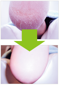 香川県高松市での巻き爪補正・角質ケア・耳ツボダイエットなら原野鍼灸整骨院へ