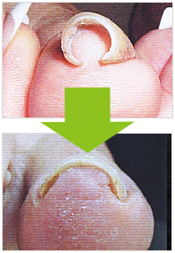 香川県高松市での巻き爪補正・角質ケア・耳ツボダイエットなら原野鍼灸整骨院へ