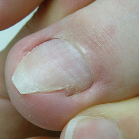 陥入爪型1 施術前