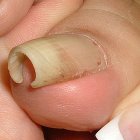 ストロー型2 施術前