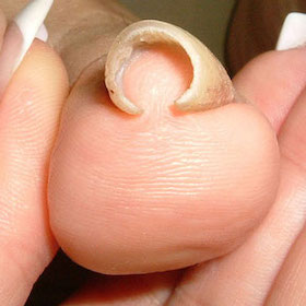 ストロー型1 施術前