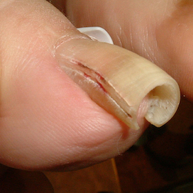 ストロー型3 施術前