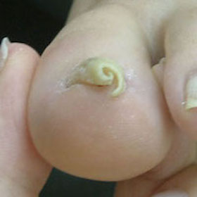 渦巻き型1 施術前