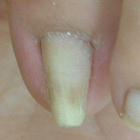 渦巻き型3 施術前