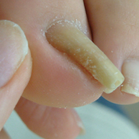 渦巻き型2 施術前